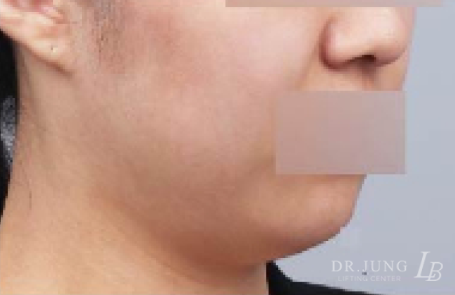 얼굴지방흡입 전 - 케이스 5
