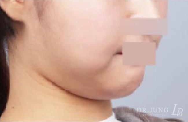 얼굴지방흡입 전 - 케이스 8