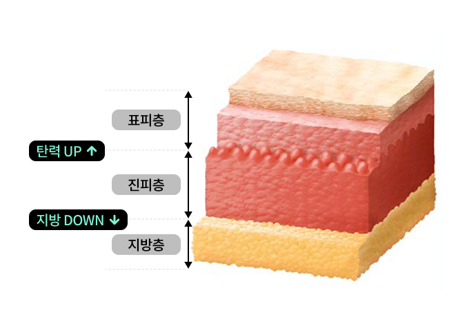 파워v 얼굴지방흡입