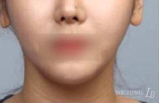 실루엣소프트 후 - 케이스 1