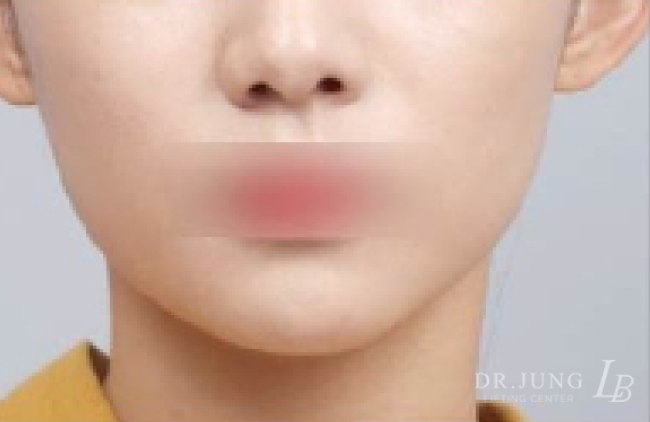 실루엣소프트 후 - 케이스 3