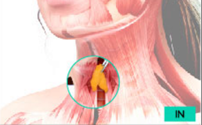 근육 깊은 안쪽 지방까지 제거