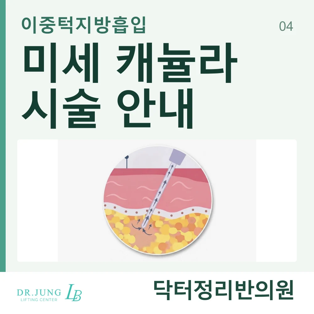 미세 캐뉼라를 이용하는 이중턱지방흡입 방식 안내